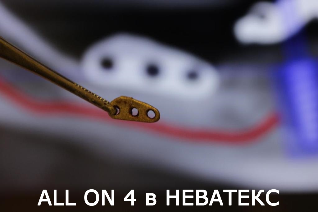 All on four - технология восстановления зубов на 4 имплантах технология на 4 имплантах all on four